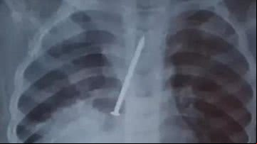 O menino de 3 anos que ficou com prego em seu pulmão - Divulgação/ TV Bahia